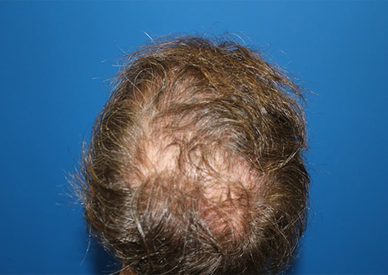 PRP Hair Restoration Before & After Gallery - Patient 308715 - Image 1