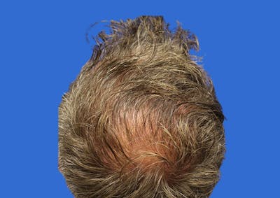 PRP Hair Restoration Before & After Gallery - Patient 308715 - Image 2