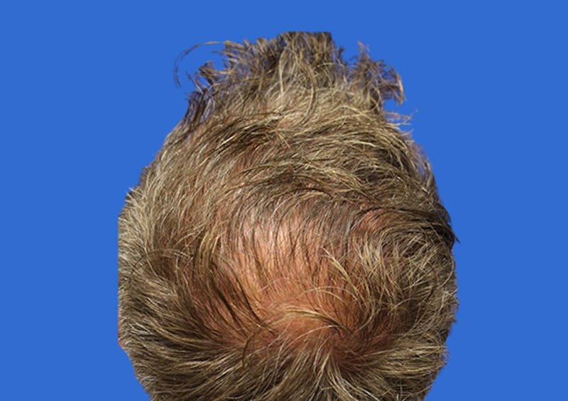 PRP Hair Restoration Before & After Gallery - Patient 308715 - Image 2