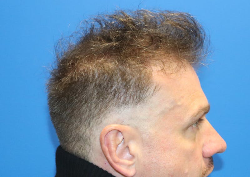 PRP Hair Restoration Before & After Gallery - Patient 308715 - Image 3