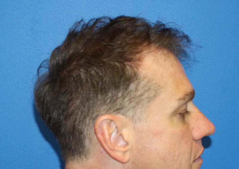 PRP Hair Restoration Before & After Gallery - Patient 308715 - Image 4
