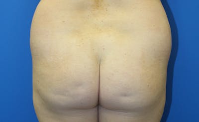 Brazilian Butt Lift Before & After Gallery - Patient 379232 - Image 1