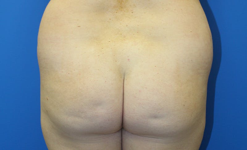 Brazilian Butt Lift Before & After Gallery - Patient 379232 - Image 1