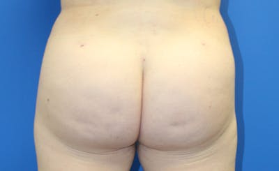 Brazilian Butt Lift Before & After Gallery - Patient 379232 - Image 2