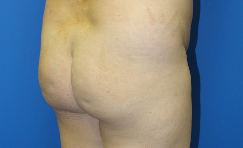 Brazilian Butt Lift Before & After Gallery - Patient 379232 - Image 3