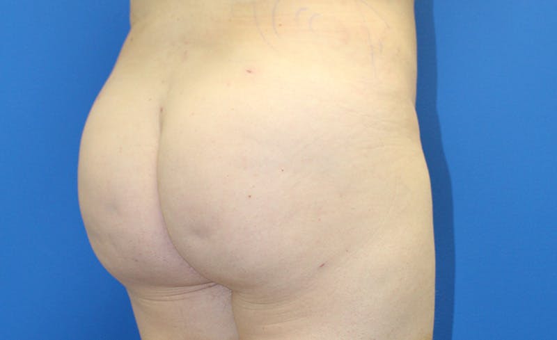 Brazilian Butt Lift Before & After Gallery - Patient 379232 - Image 4