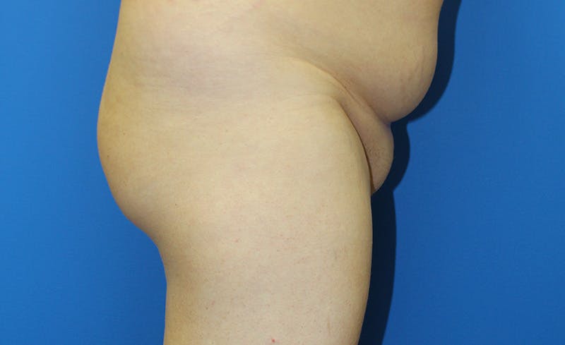 Brazilian Butt Lift Before & After Gallery - Patient 379232 - Image 5