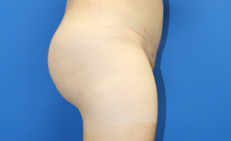 Brazilian Butt Lift Before & After Gallery - Patient 379232 - Image 6
