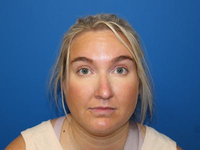 Letybo Before & After Gallery - Patient 121906 - Image 2