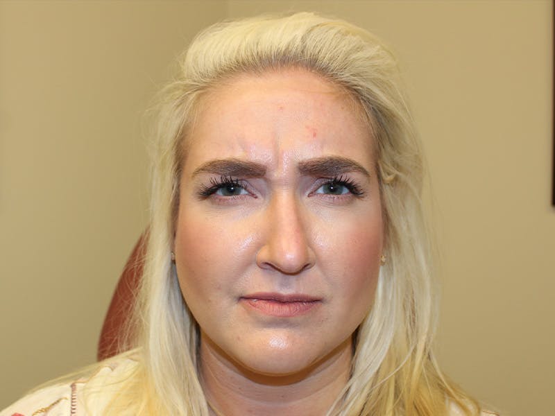 Letybo Before & After Gallery - Patient 121906 - Image 3