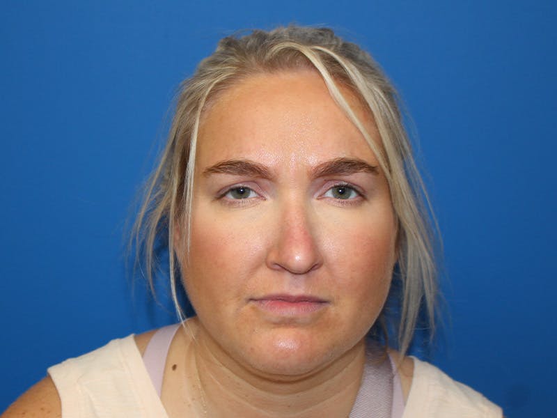 Letybo Before & After Gallery - Patient 121906 - Image 4