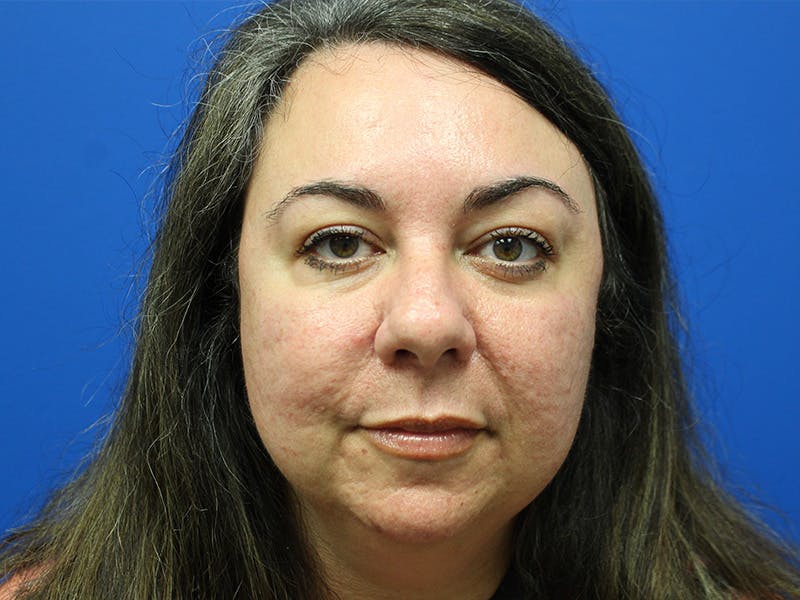 Letybo Before & After Gallery - Patient 378192 - Image 2