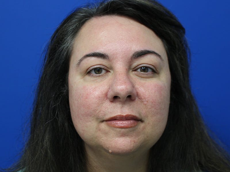Letybo Before & After Gallery - Patient 378192 - Image 6
