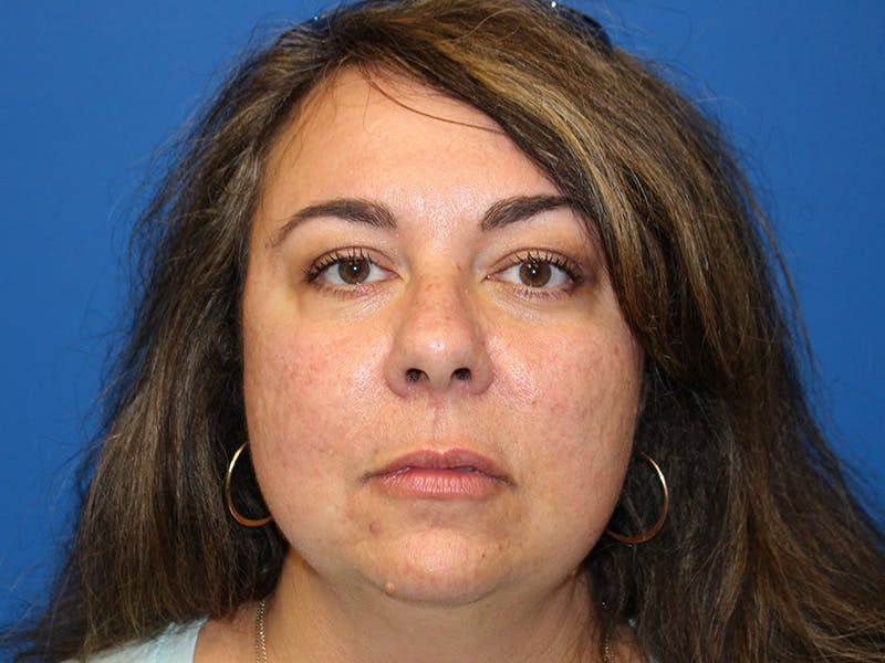 Letybo Before & After Gallery - Patient 378192 - Image 4