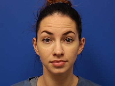 Letybo Before & After Gallery - Patient 374885 - Image 1