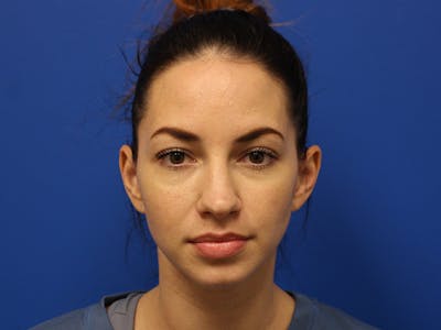 Letybo Before & After Gallery - Patient 374885 - Image 2