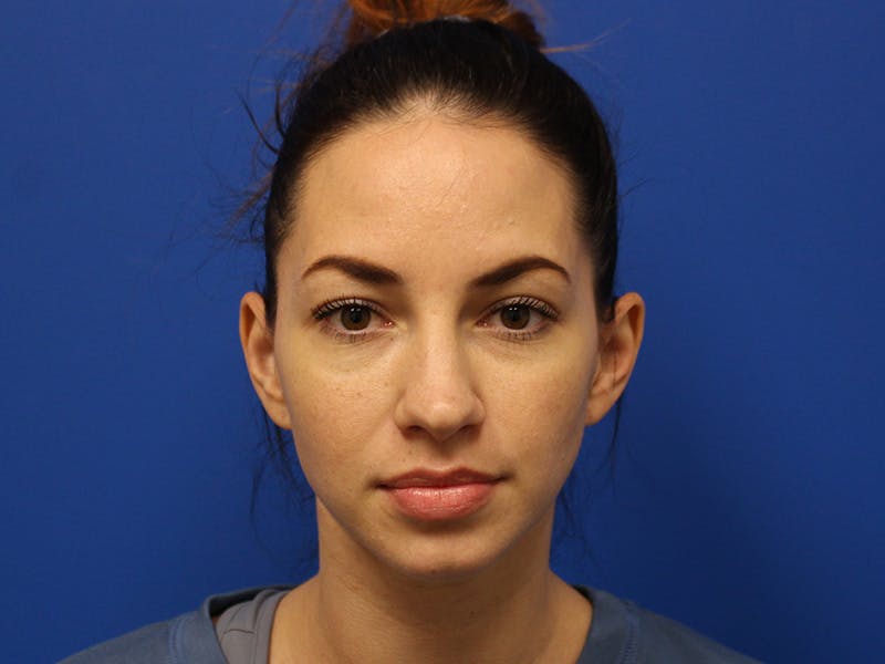 Letybo Before & After Gallery - Patient 374885 - Image 2