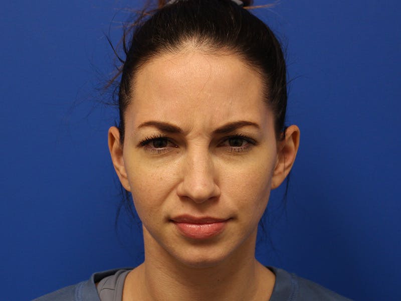 Letybo Before & After Gallery - Patient 374885 - Image 4