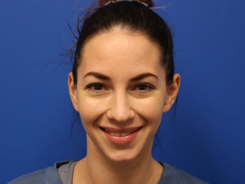 Letybo Before & After Gallery - Patient 374885 - Image 3
