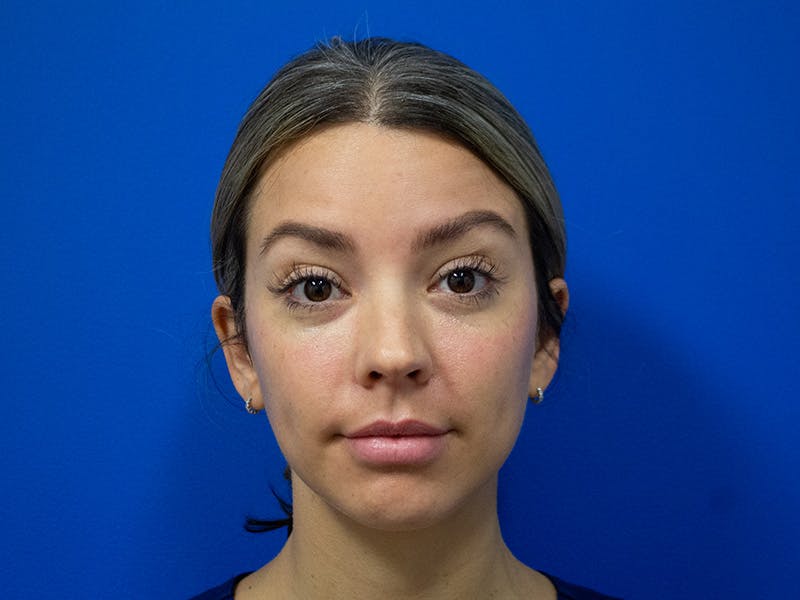 Botox Xeomin Before & After Gallery - Patient 290875 - Image 3