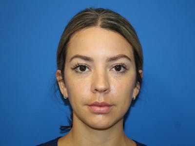 Botox Xeomin Before & After Gallery - Patient 290875 - Image 2