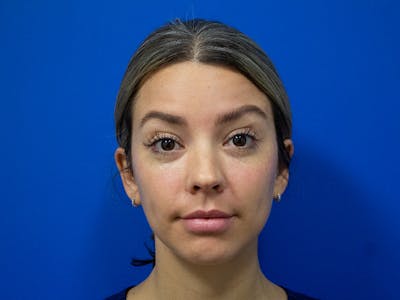 Botox Xeomin Before & After Gallery - Patient 290875 - Image 1