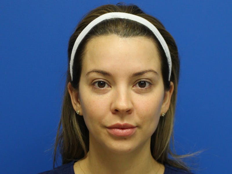 Botox Xeomin Before & After Gallery - Patient 290875 - Image 4