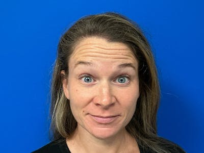 Botox Xeomin Before & After Gallery - Patient 376917 - Image 1