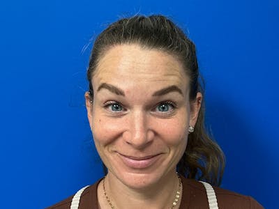 Botox Xeomin Before & After Gallery - Patient 376917 - Image 2
