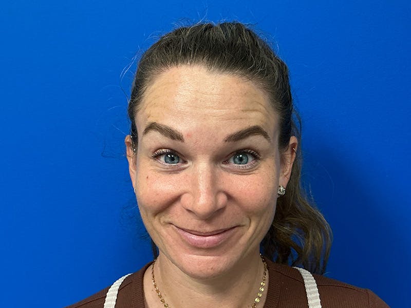 Botox Xeomin Before & After Gallery - Patient 376917 - Image 2