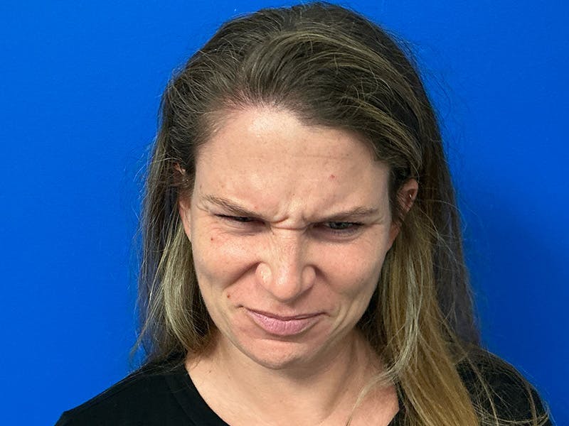 Botox Xeomin Before & After Gallery - Patient 376917 - Image 3
