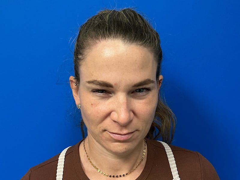 Botox Xeomin Before & After Gallery - Patient 376917 - Image 4