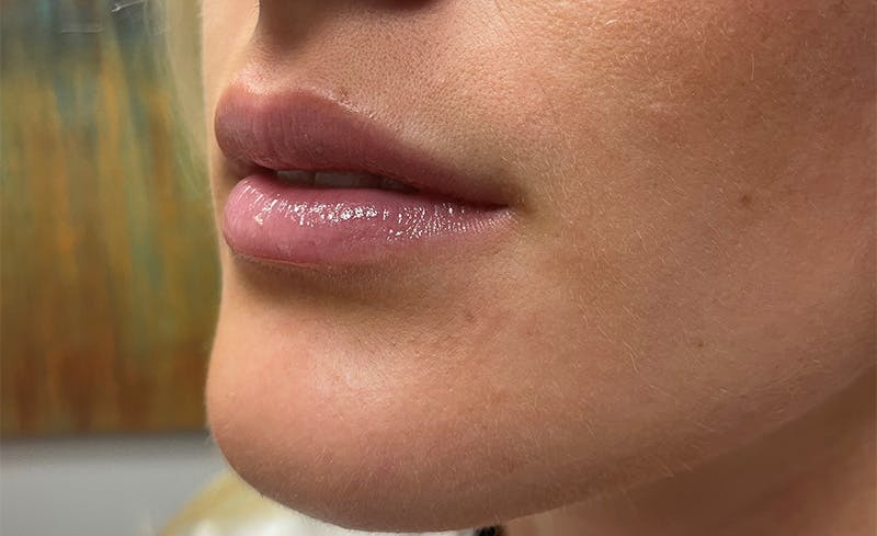 Facial Fillers Before & After Gallery - Patient 715523 - Image 3