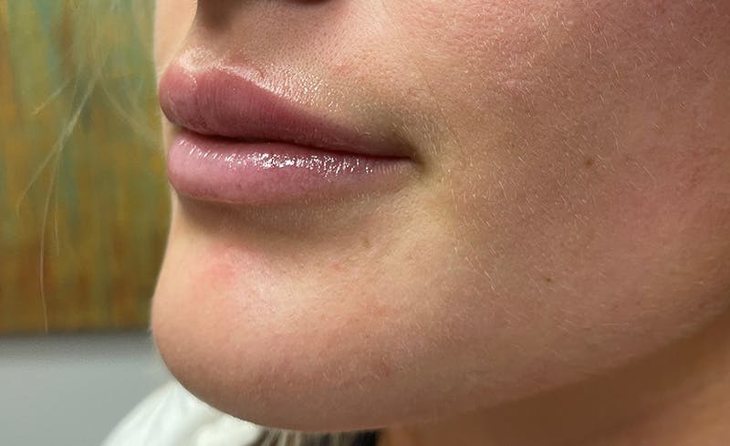 Facial Fillers Before & After Gallery - Patient 715523 - Image 4