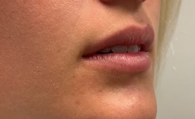 Facial Fillers Before & After Gallery - Patient 715523 - Image 1