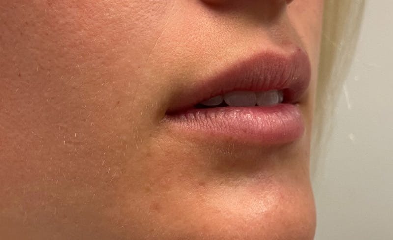 Facial Fillers Before & After Gallery - Patient 715523 - Image 1