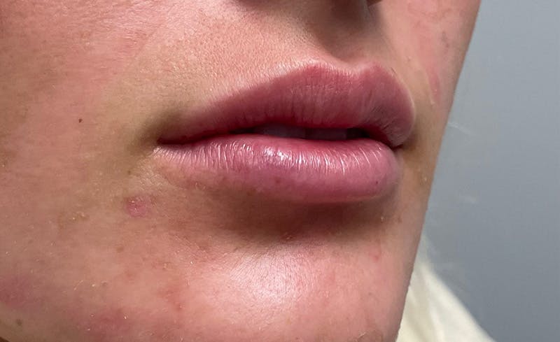Facial Fillers Before & After Gallery - Patient 715523 - Image 2