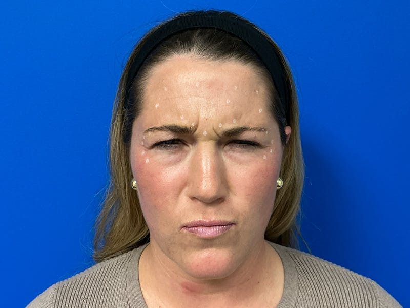 Botox Xeomin Before & After Gallery - Patient 296002 - Image 1