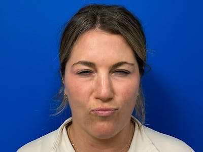 Botox Xeomin Before & After Gallery - Patient 296002 - Image 2