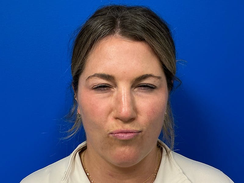 Botox Xeomin Before & After Gallery - Patient 296002 - Image 2
