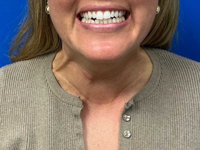 Botox Xeomin Before & After Gallery - Patient 296002 - Image 3