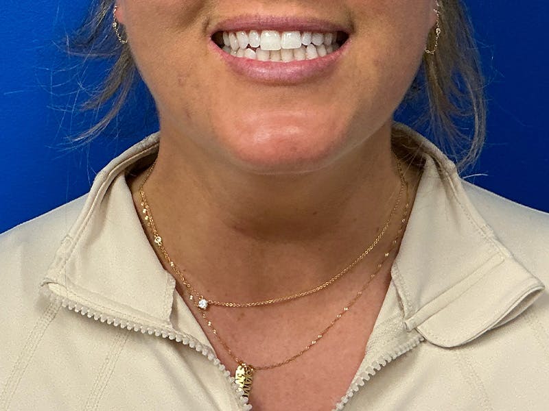 Botox Xeomin Before & After Gallery - Patient 296002 - Image 4