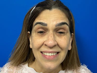 Botox Xeomin Before & After Gallery - Patient 303507 - Image 1