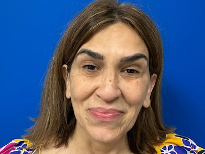 Botox Xeomin Before & After Gallery - Patient 303507 - Image 2