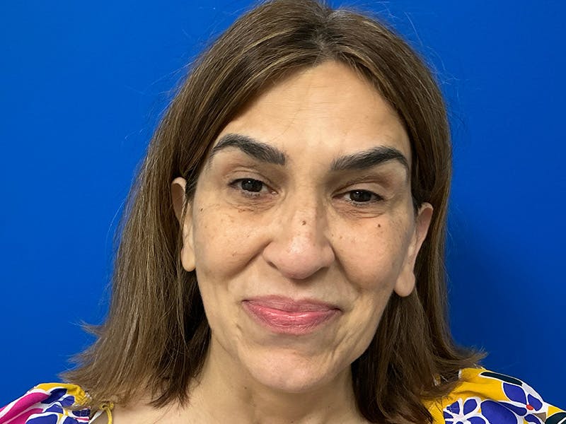 Botox Xeomin Before & After Gallery - Patient 303507 - Image 2