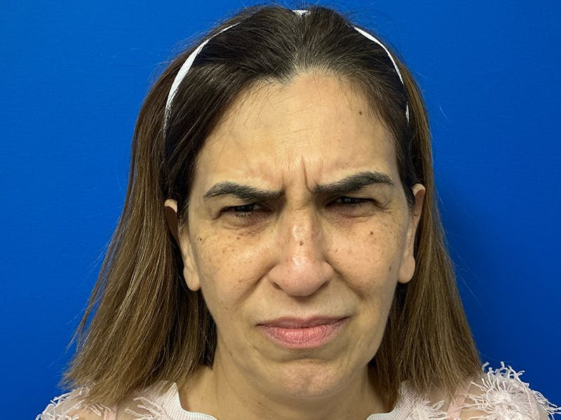 Botox Xeomin Before & After Gallery - Patient 303507 - Image 3