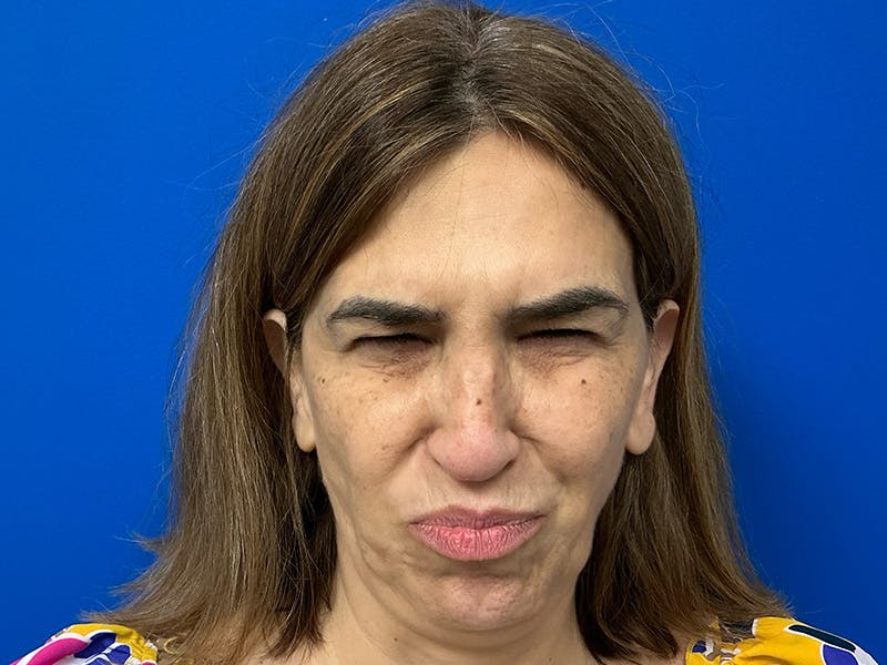 Botox Xeomin Before & After Gallery - Patient 303507 - Image 4