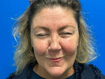 Botox Xeomin Before & After Gallery - Patient 925350 - Image 2