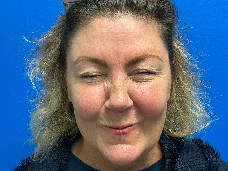 Botox Xeomin Before & After Gallery - Patient 925350 - Image 2