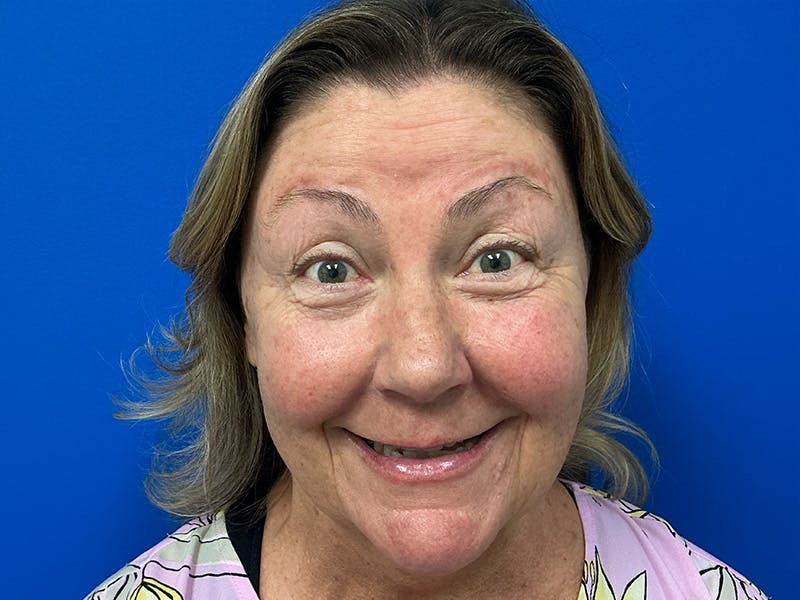 Botox Xeomin Before & After Gallery - Patient 925350 - Image 3